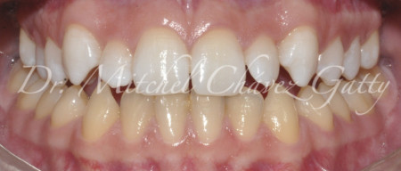 El Blanqueamiento Dental es un tratamiento que debe ser supervisado por el dentista.